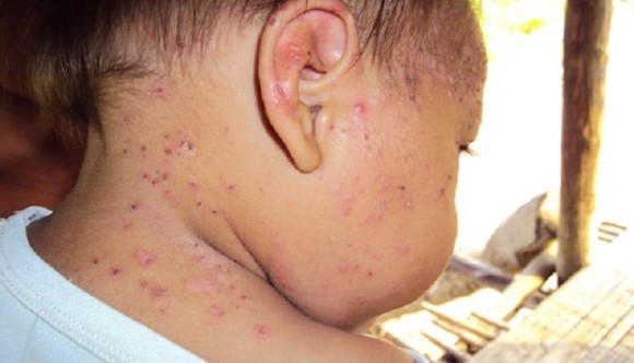 feconaco consecuencias hidrocarburos en salud